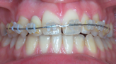 orthodontie saint mande