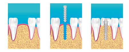 implant dentaire protocole